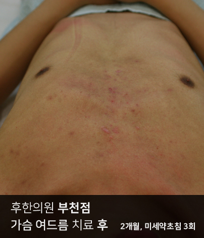 부천가슴여드름치료 시술 후