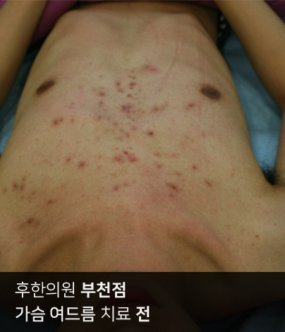 부천가슴여드름치료 시술 전