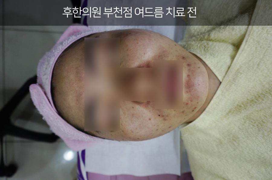 부천얼굴여드름 치료 전