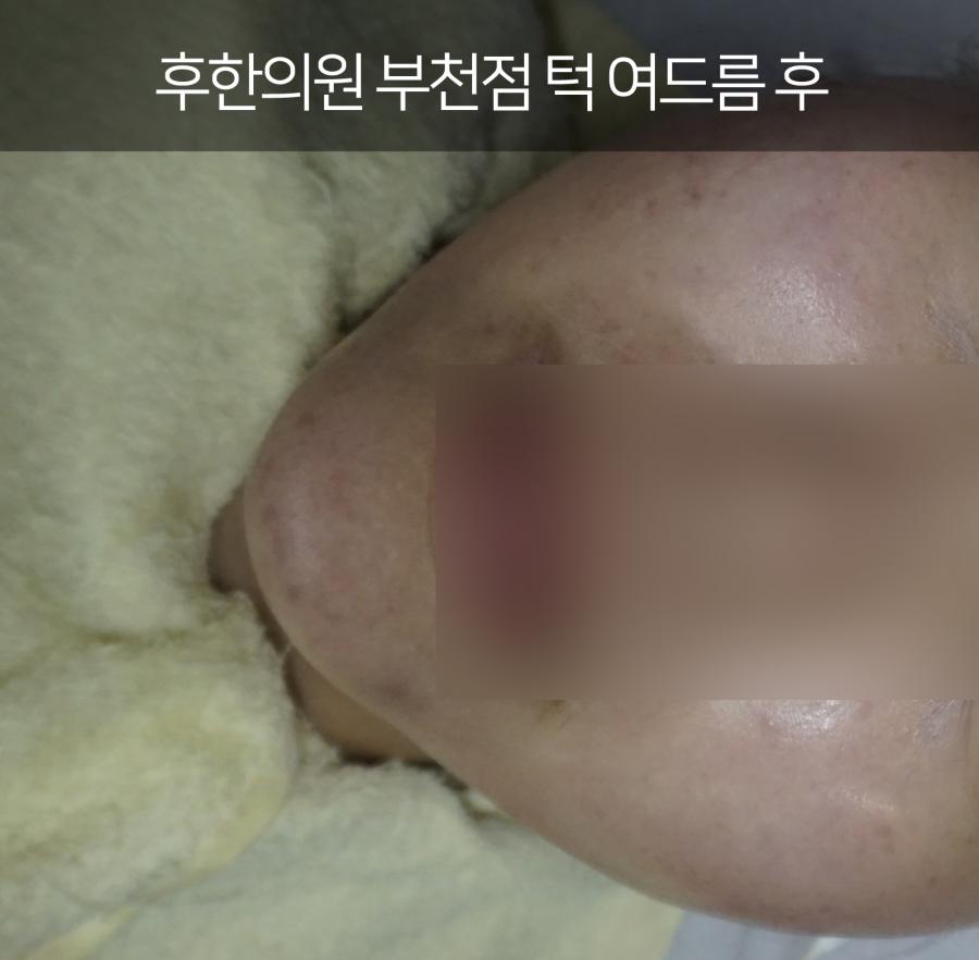 부천턱드름 치료후