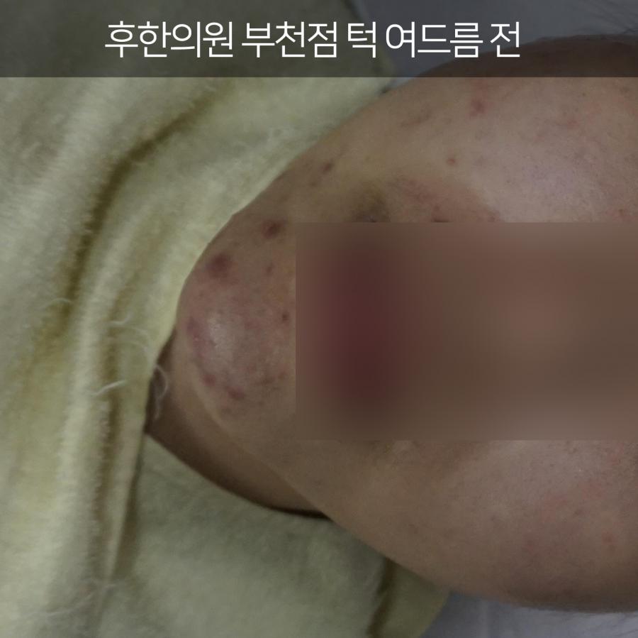 부천턱드름 치료전