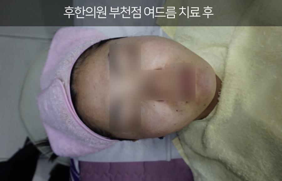 부천얼굴여드름 치료 후