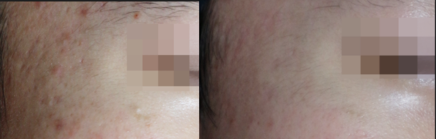 부천새살침 관자놀이 치료 전후