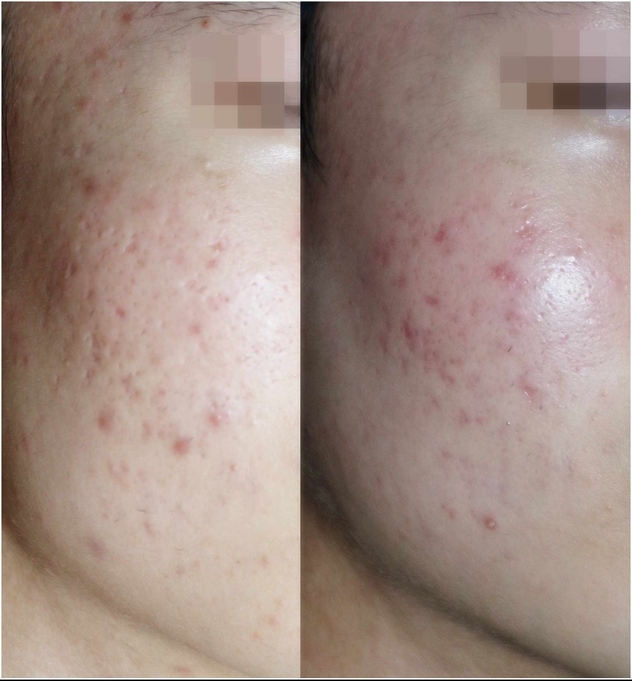부천새살침 붉어진 볼 치료 패임 전후 개선된 사진