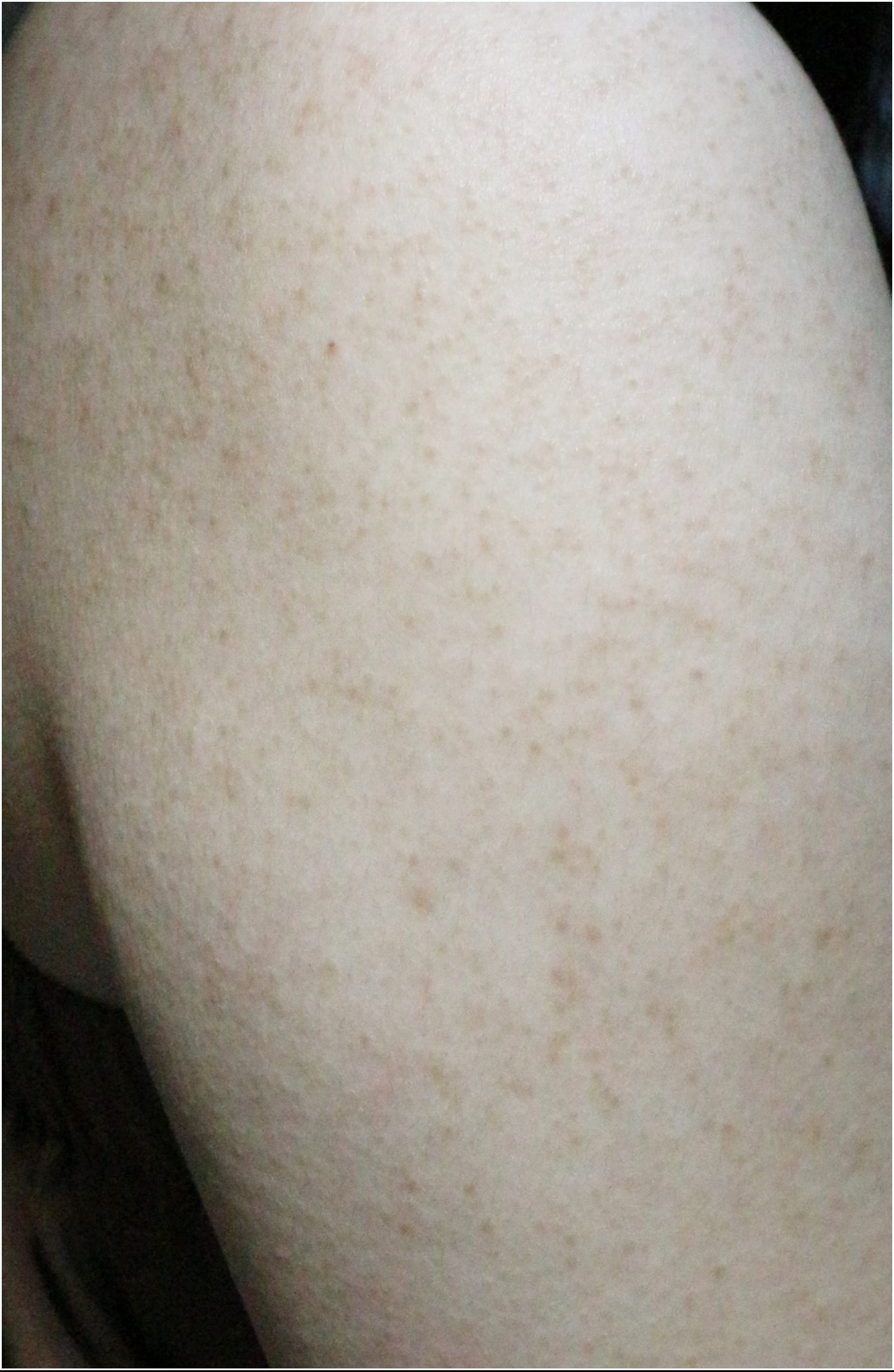 부천모공각화증 치료 전 사진