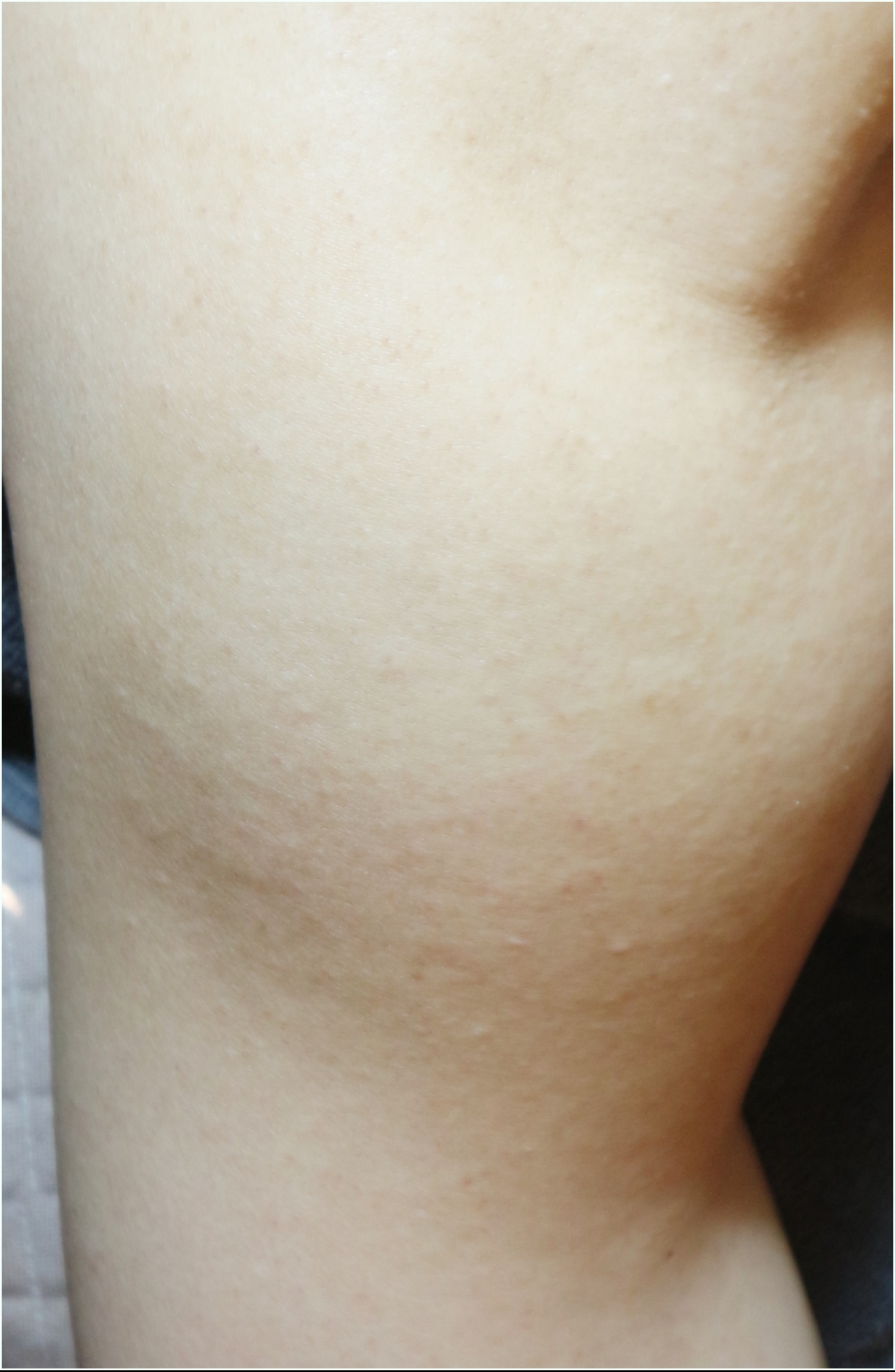 부천모공각화증 팔 치료 후
