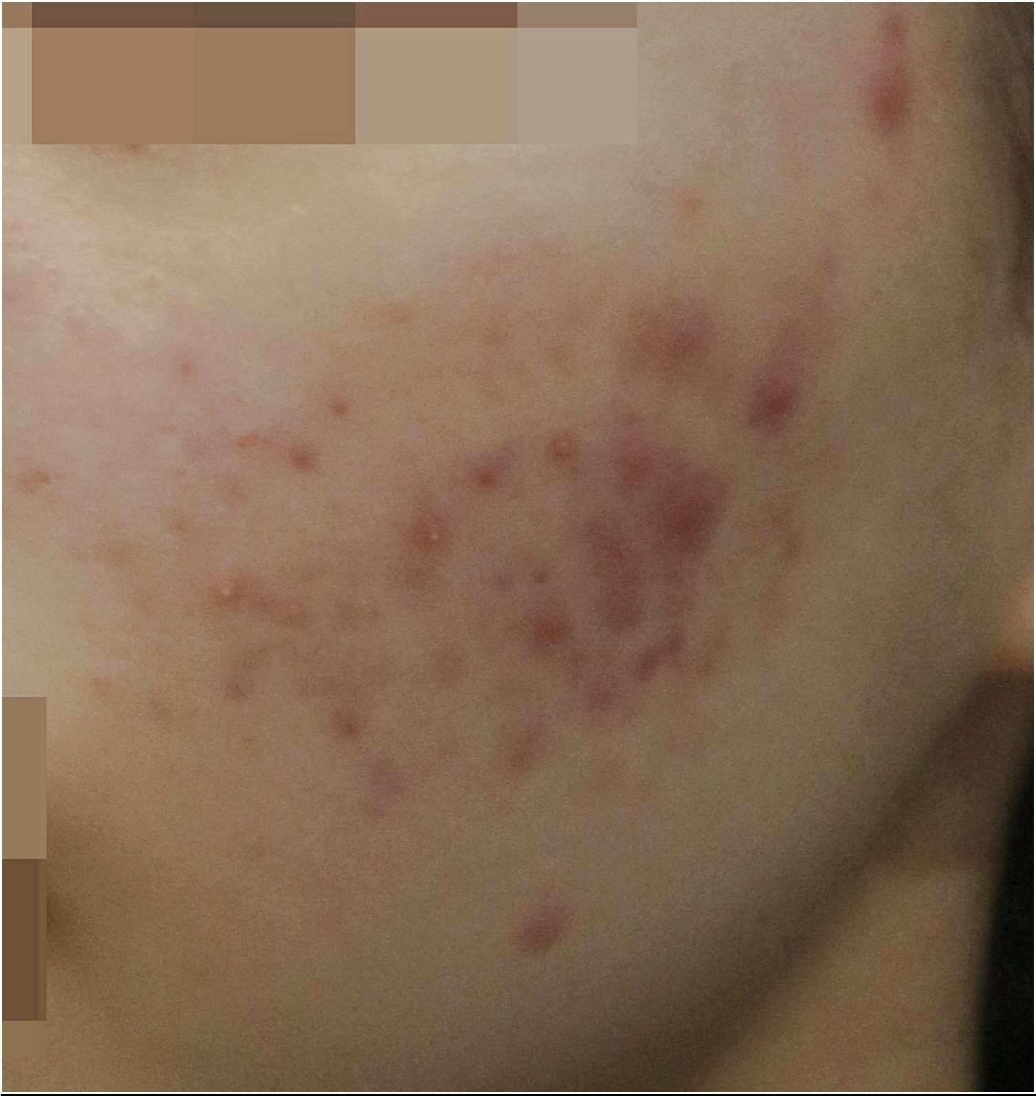부천여드름한의원 볼여드름 치료 전