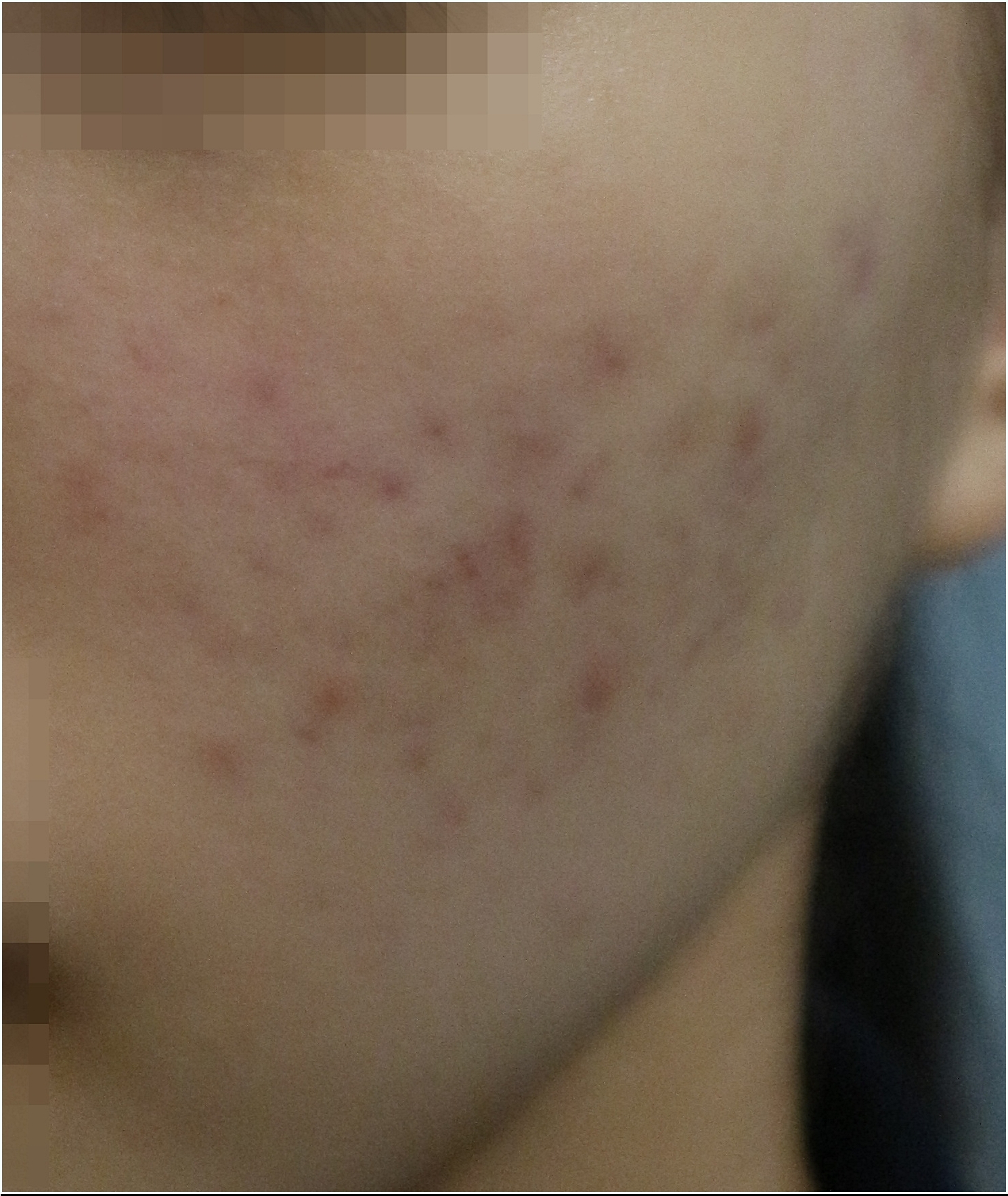 부천여드름한의원 볼 부분 2개월차 치료 변화