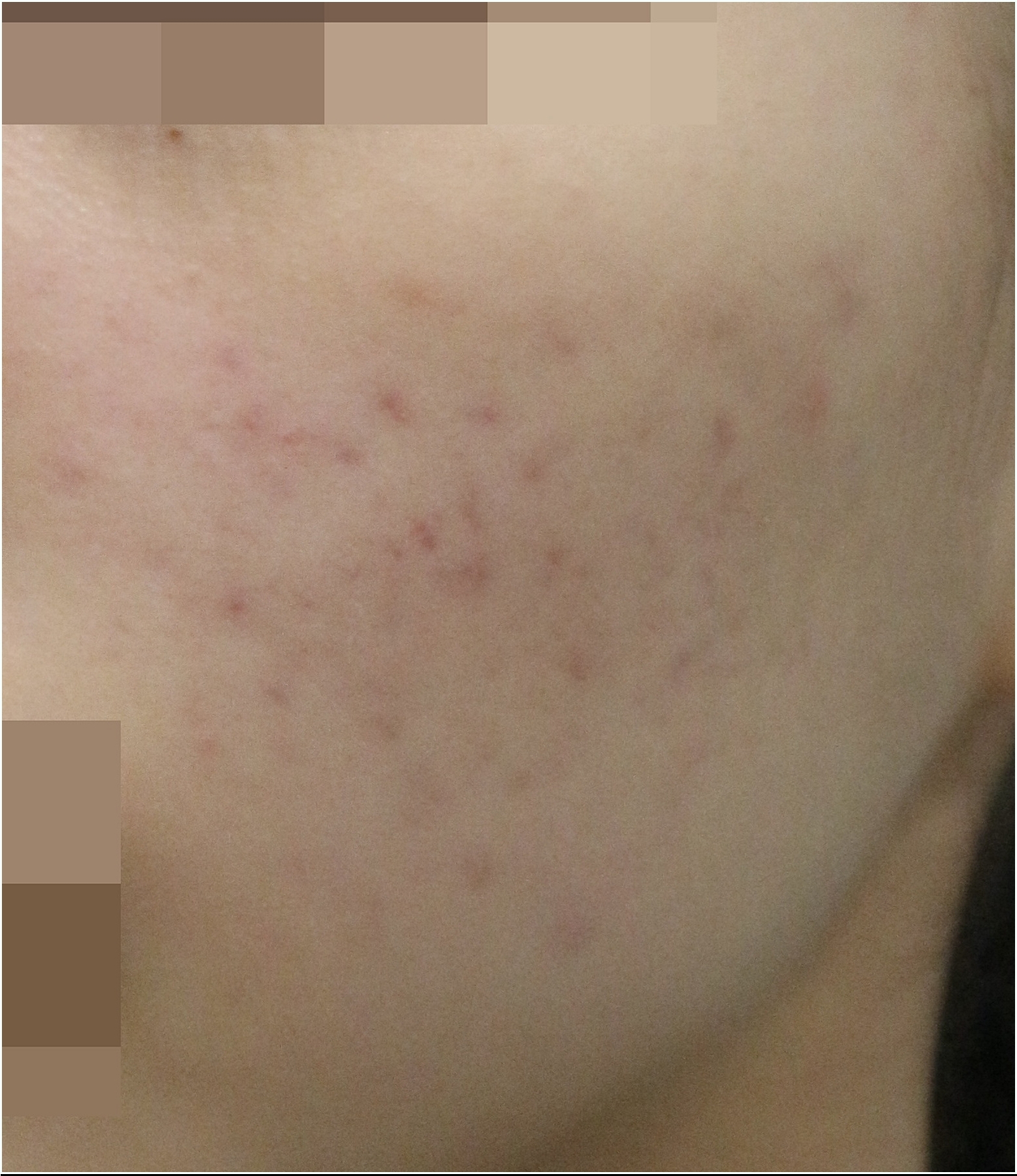부천여드름한의원 볼 여드름 치료 삼개월 차