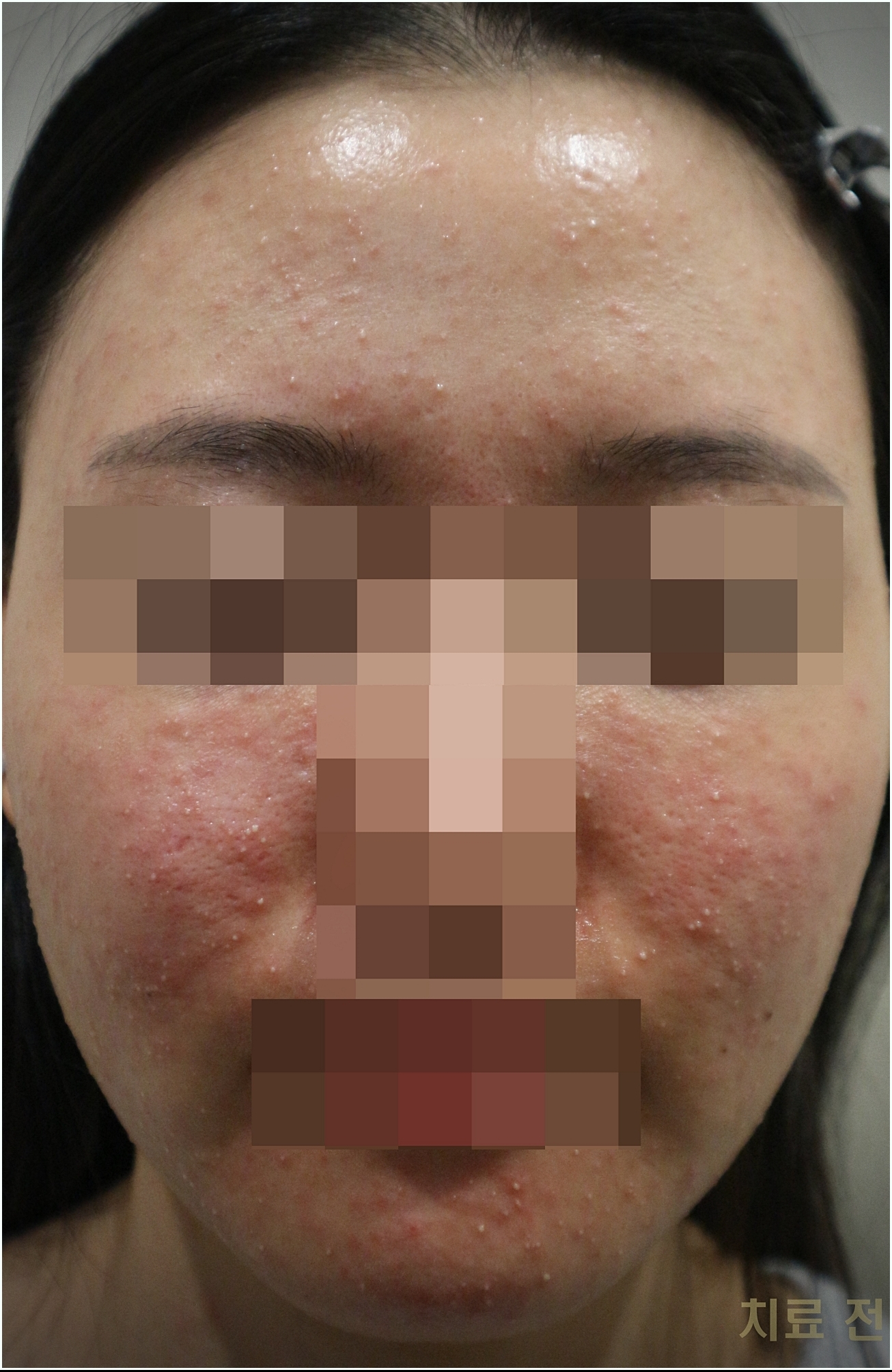 부천모낭염 치료 전 여자 사진