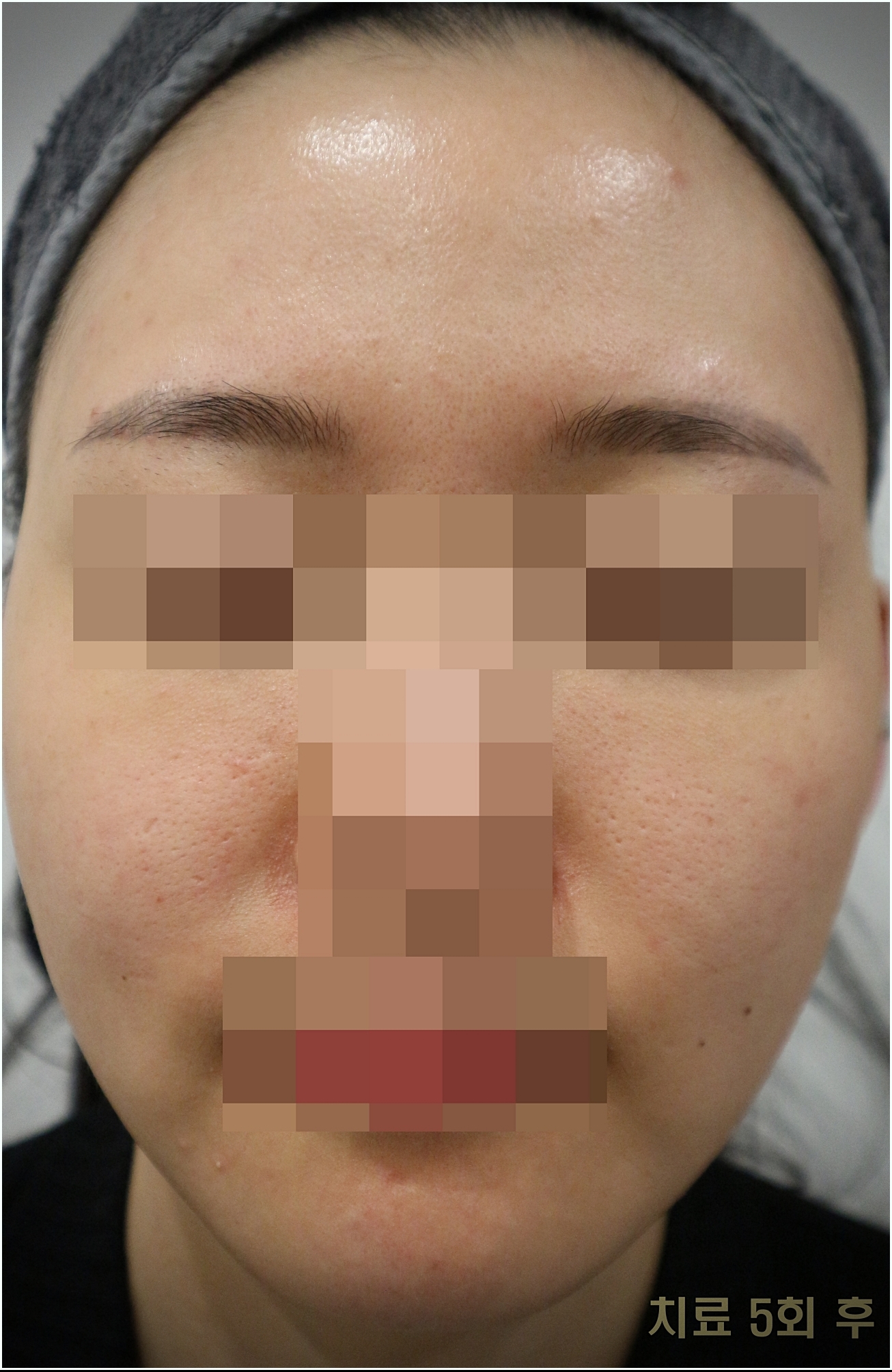 부천모낭염 치료 5회차 얼굴 전체