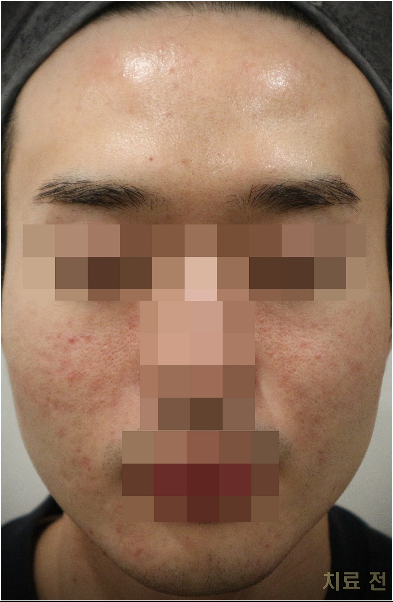 부천모낭염 남자 케이스 전