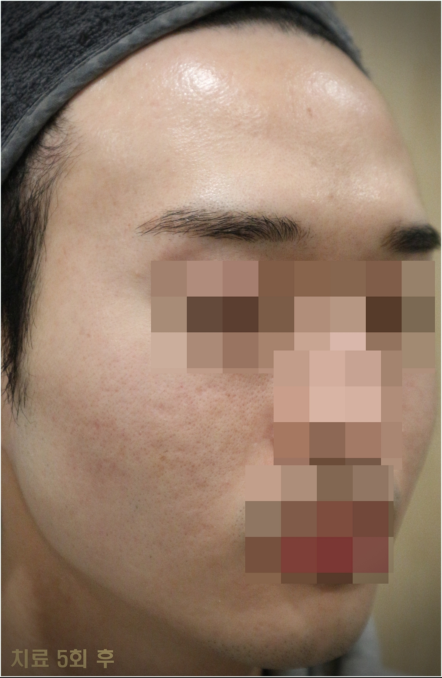 부천모낭염 남자 얼굴 변한 사진 치료의 역할