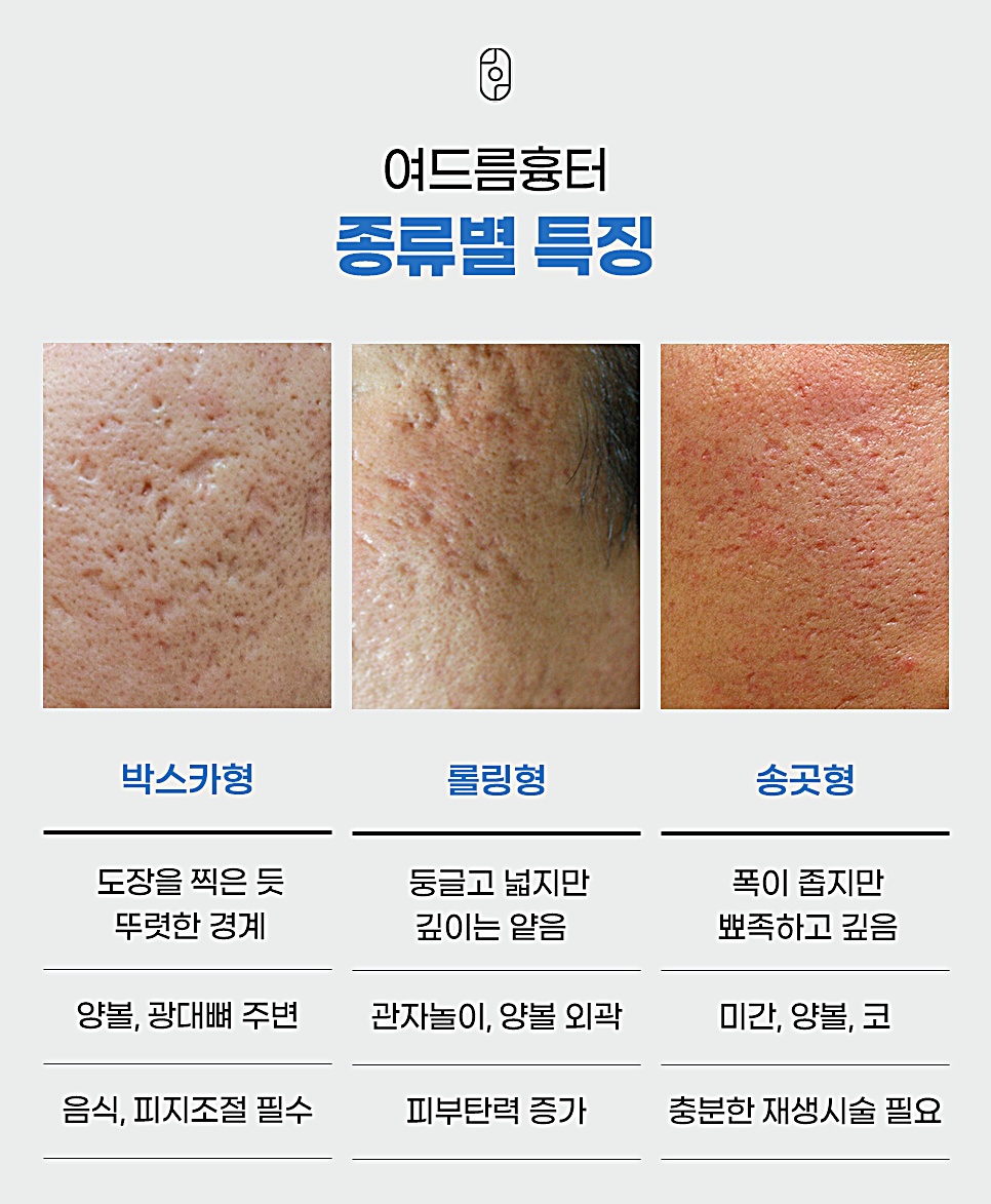 부천 여드름흉터 종류별 특징 비교, 박스카형·롤링형·송곳형