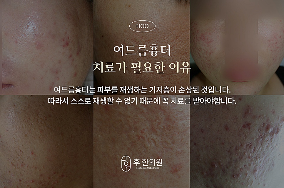 여드름흉터 치료가 필요한 이유, 후한의원 부천점