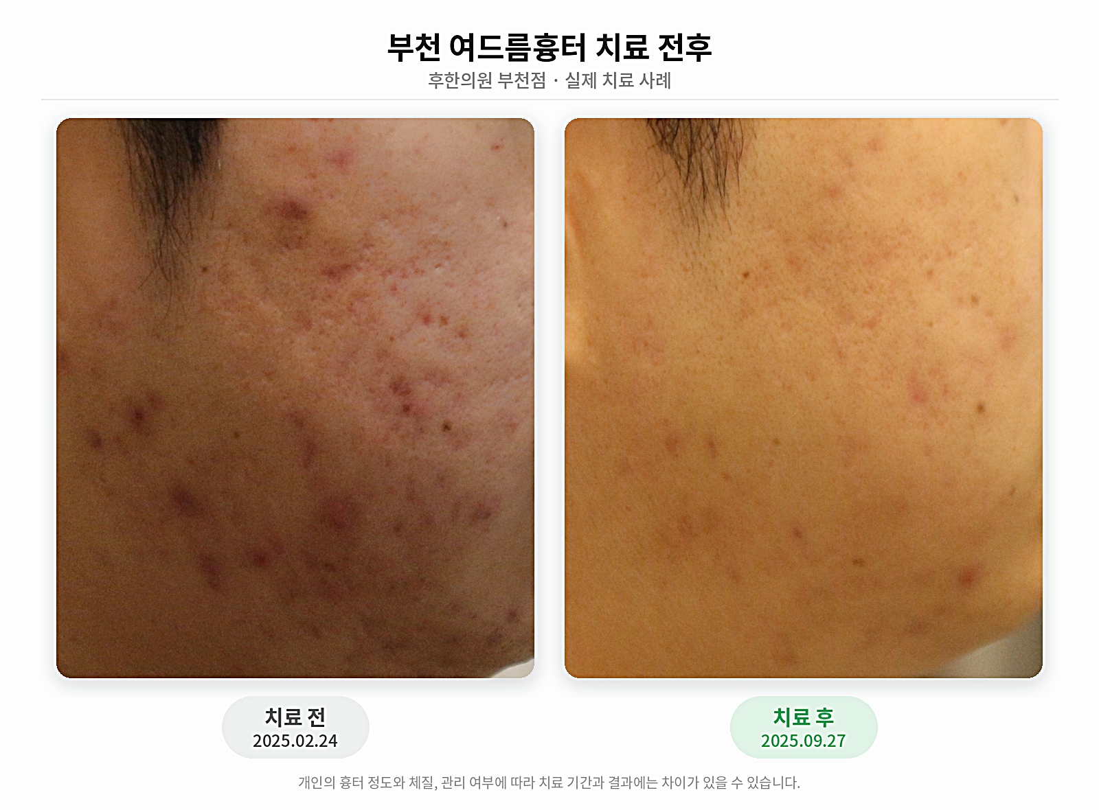 부천 여드름흉터 치료 고객의 치료 전후 비교 사진