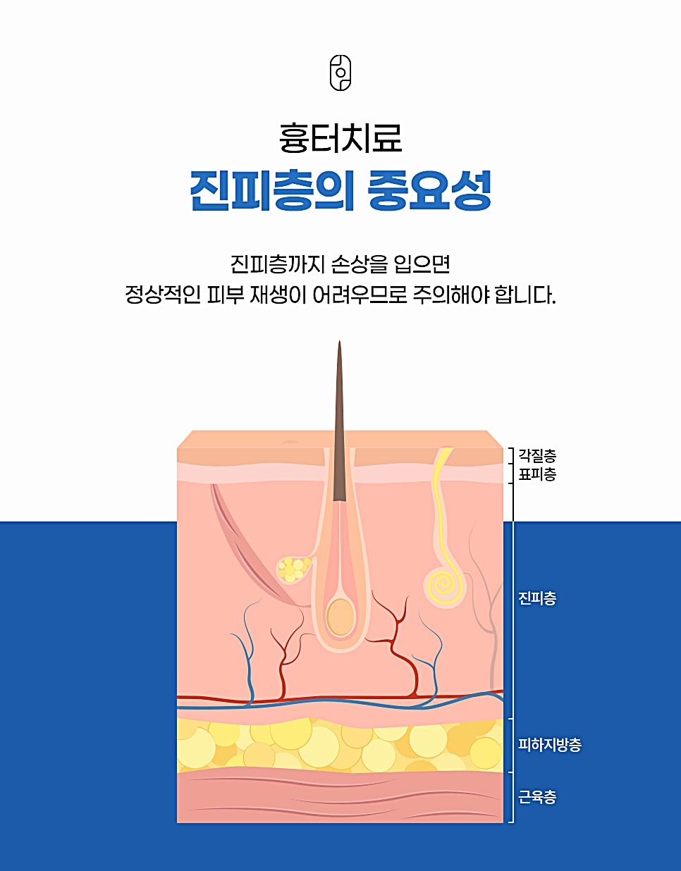 여드름흉터 치료 시 진피층 손상의 중요성