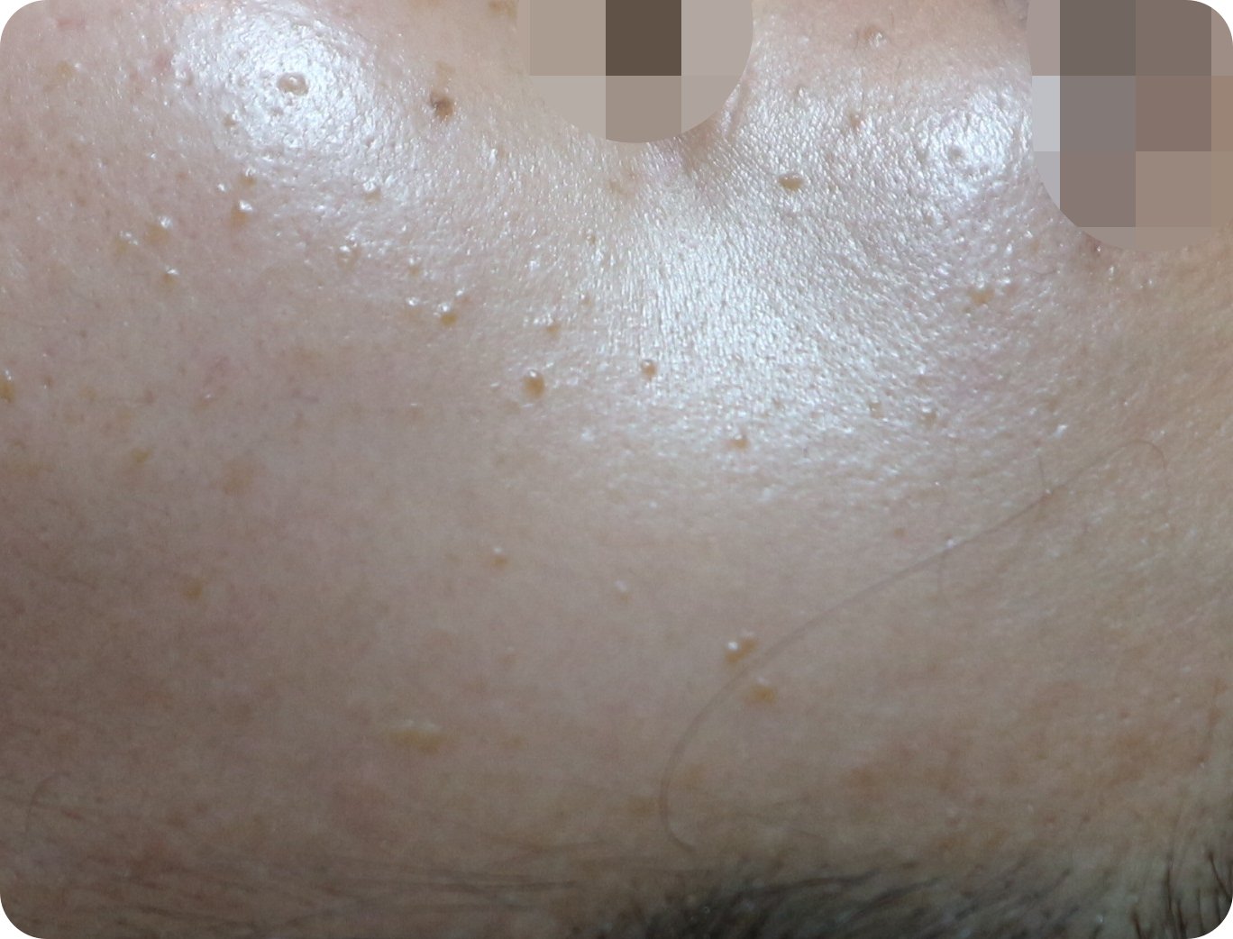 부천 편평사마귀 사율침 치료 전 뺨 사진 - 양쪽 볼에 분산된 오래된 사마귀