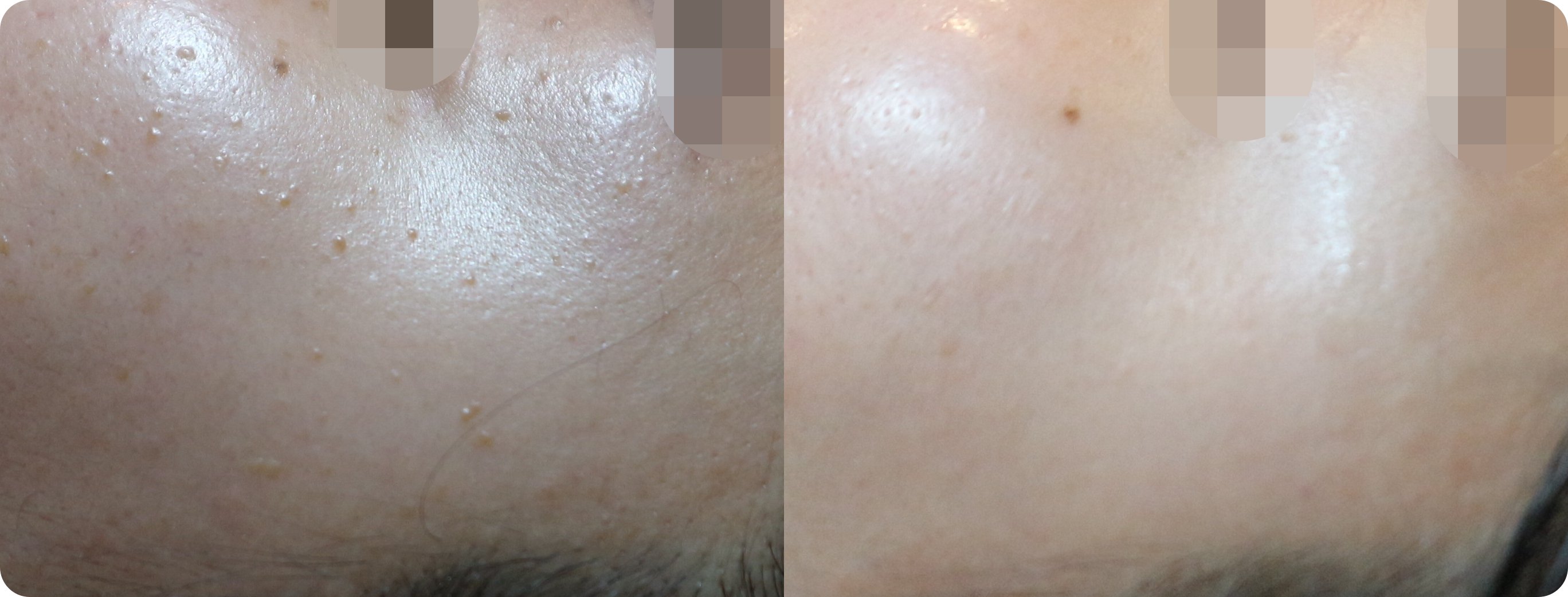 부천편평사마귀 사율침 시술 진행 중 뺨 상태 - 2개월 80% 개선된 모습