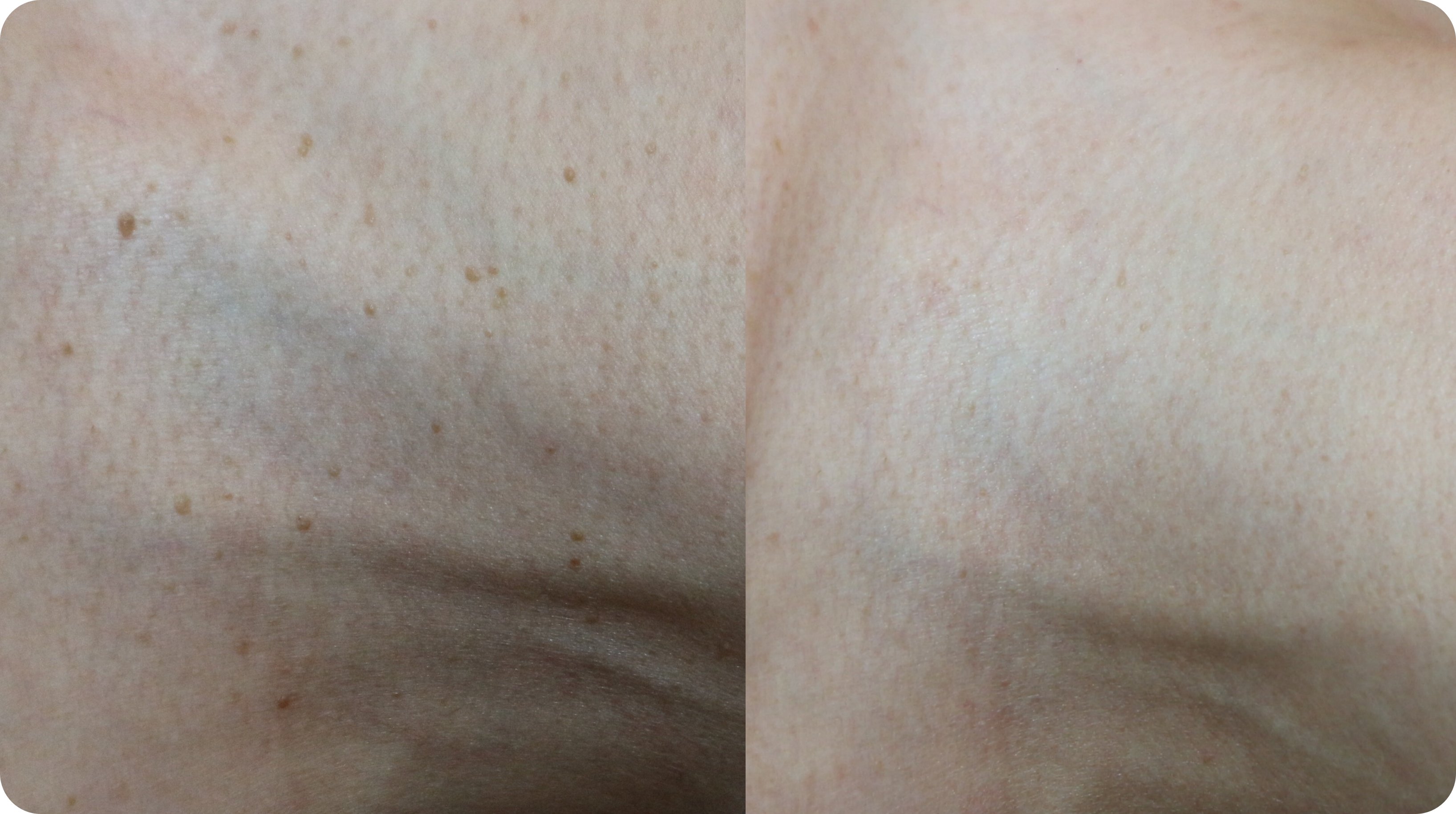 부천편평사마귀 레이저 치료 비포 애프터 -  2개월 후 개선 결과