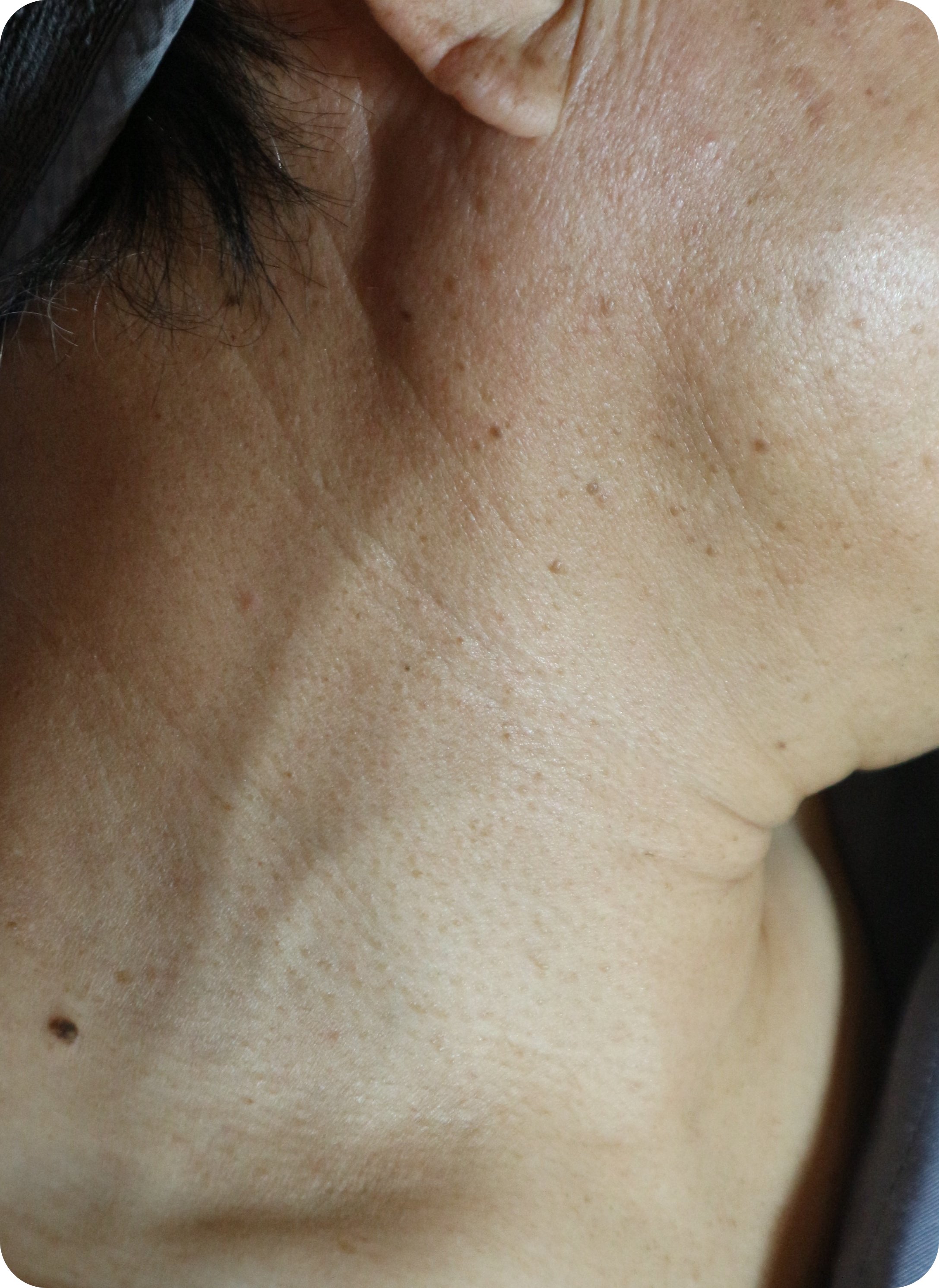 부천 편평사마귀 목 데콜테 사율침 치료 전 사진 - 목이 나이 들어 보이는 상태