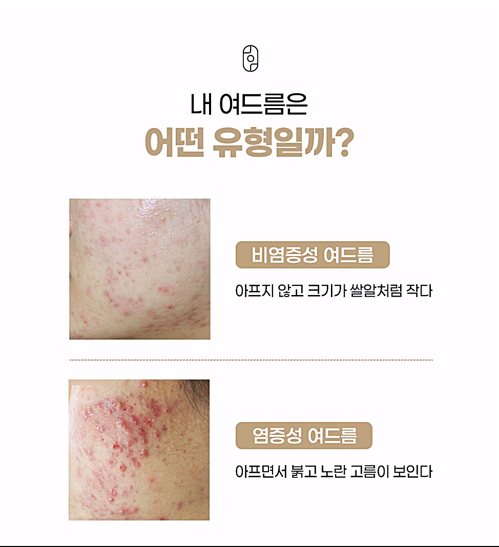 부천여드름피부과 비염증성·염증성 여드름 비교