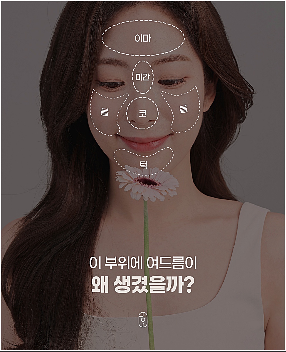 부천여드름피부과가 말하는 이마·미간·볼·코·턱 등 얼굴 부위별 여드름 원인