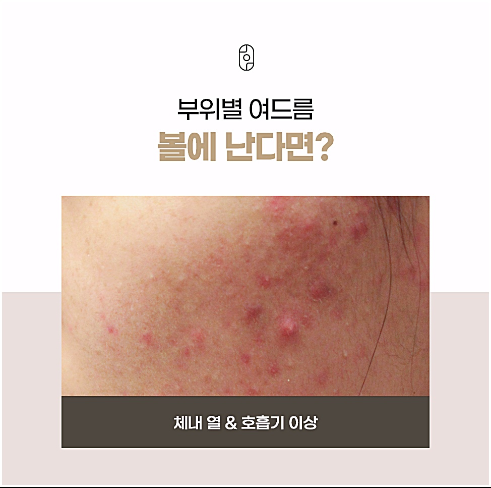 여드름 피부과 볼 여드름은 체내 열과 호흡기 이상