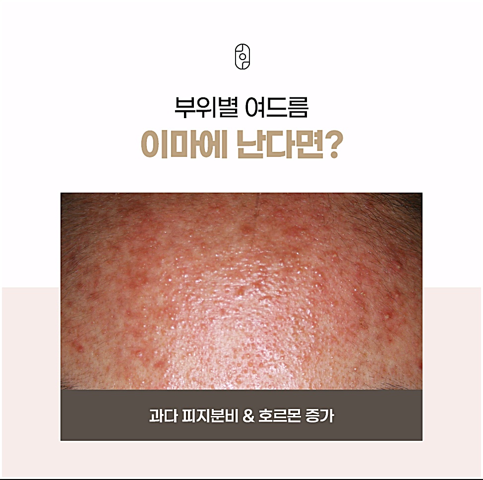 부천 여드름피부과 이마 여드름은 과다 피지분비와 호르몬 증가