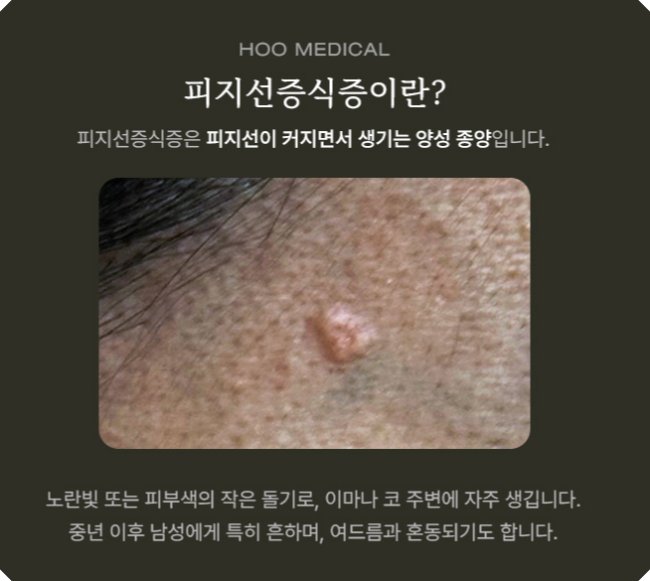 피지선증식증의 정의