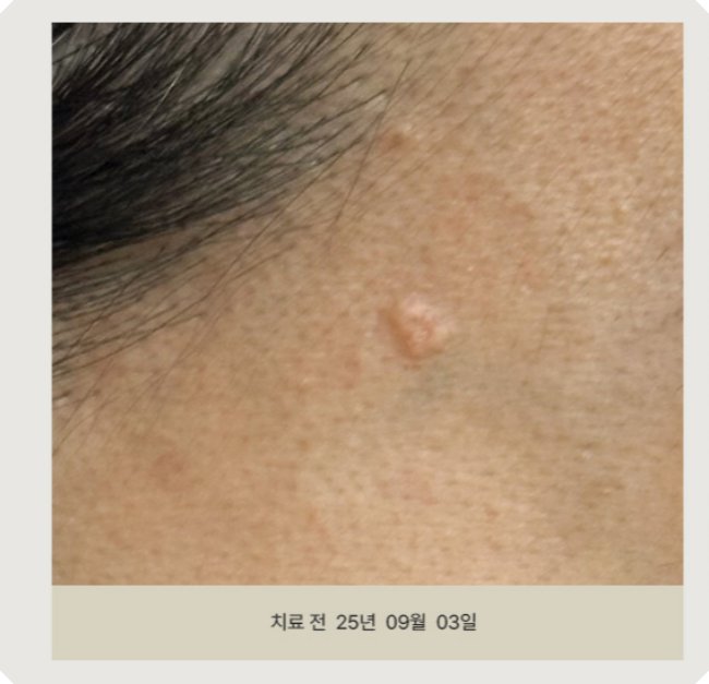 부천피지선증식증 치료 전 환자 사진 - 피부에 돌출된 피지선증식증 확인