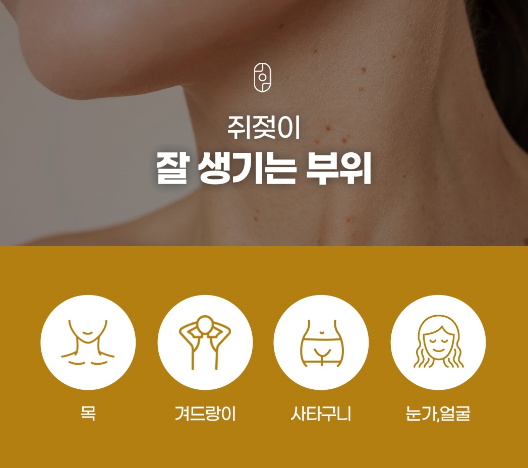 쥐젖 잘 생기는 부위 목 겨드랑이 사타구니 눈가 얼굴 안내