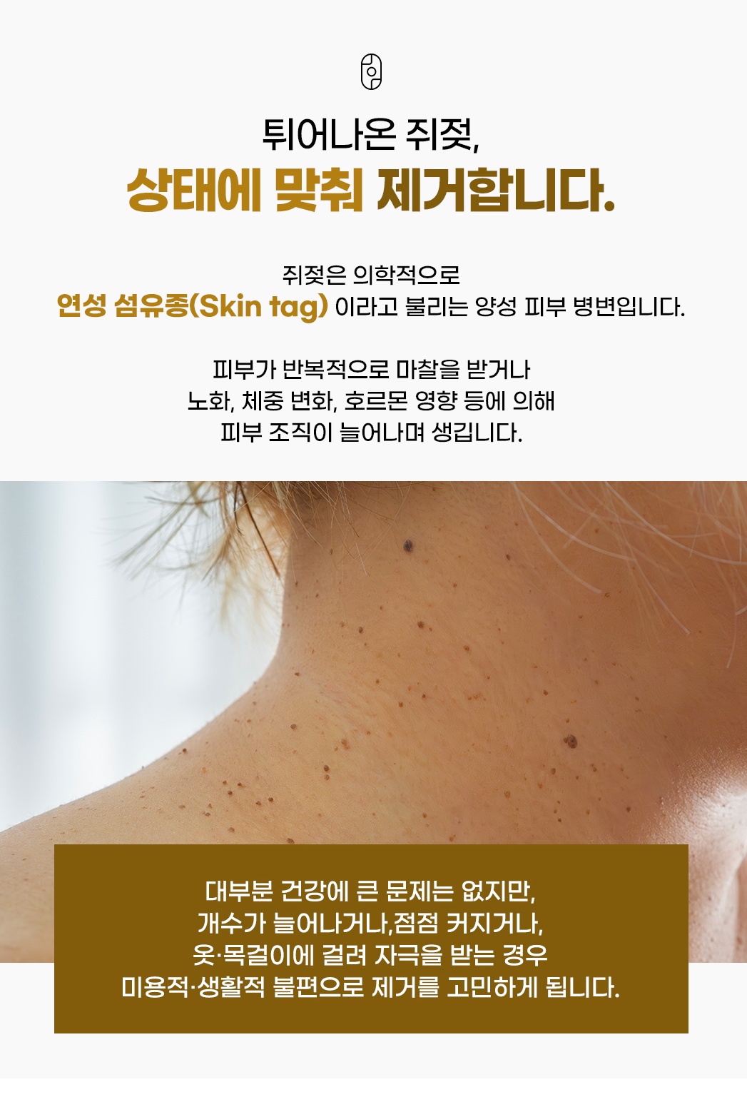 쥐젖 원인 및 연성 섬유종 마찰 노화 체중 변화 영향 안내