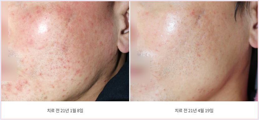 주사피부염 치료 전후 비교