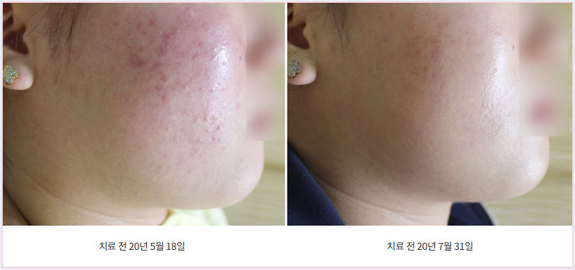 볼 부분 구진이 관찰되는 유형의 주사피부염 치료 전후