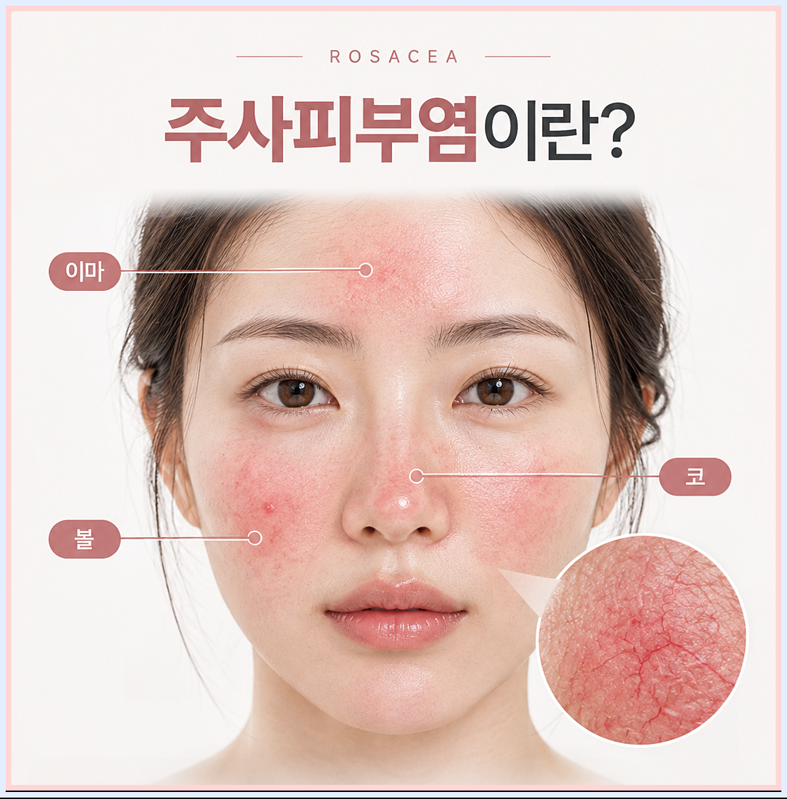 주사피부염의 정의에 대해 말하는 이미지