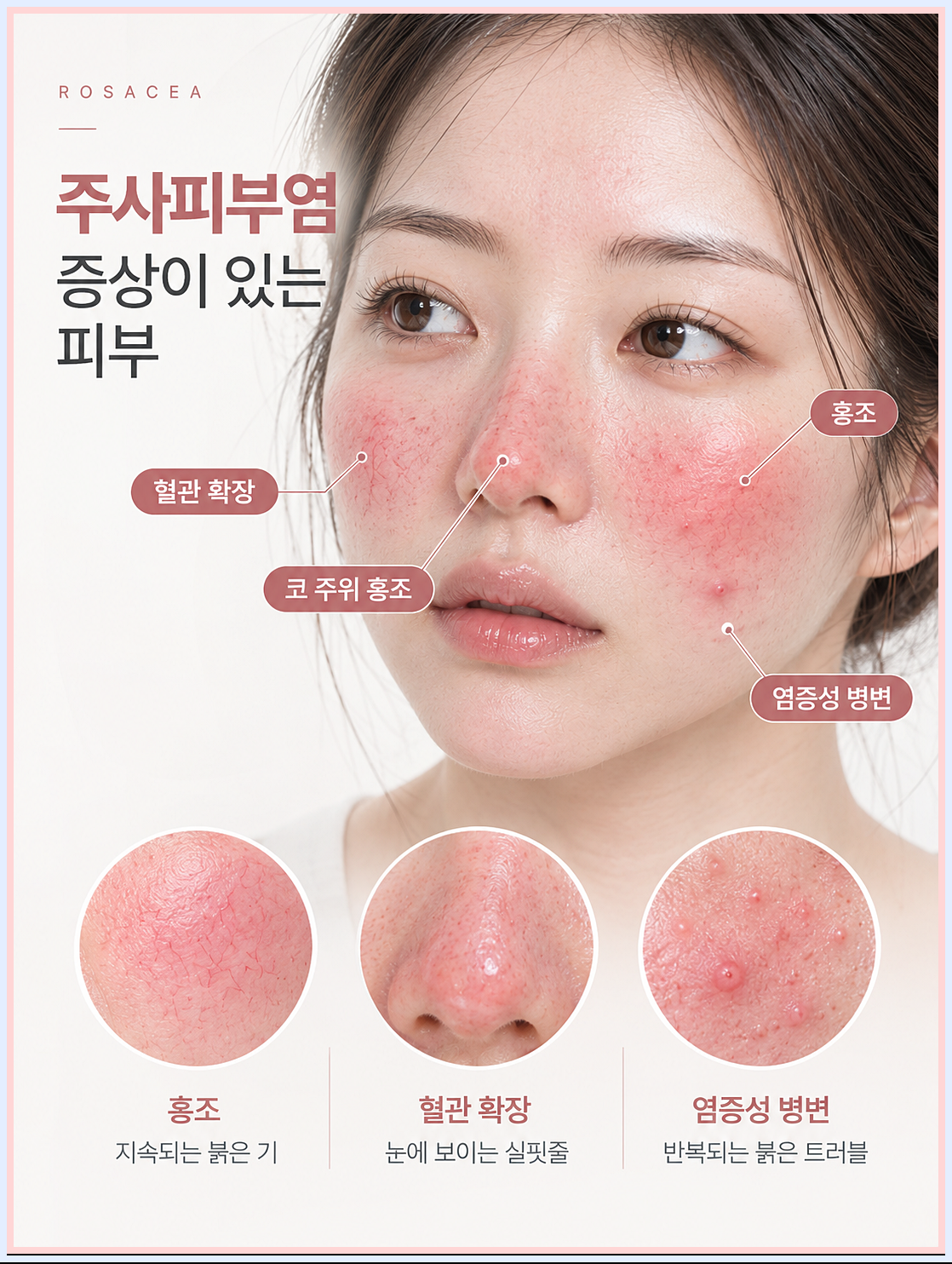 부천주사피부염치료 주사피부염 피부의 특징 정리 이미지