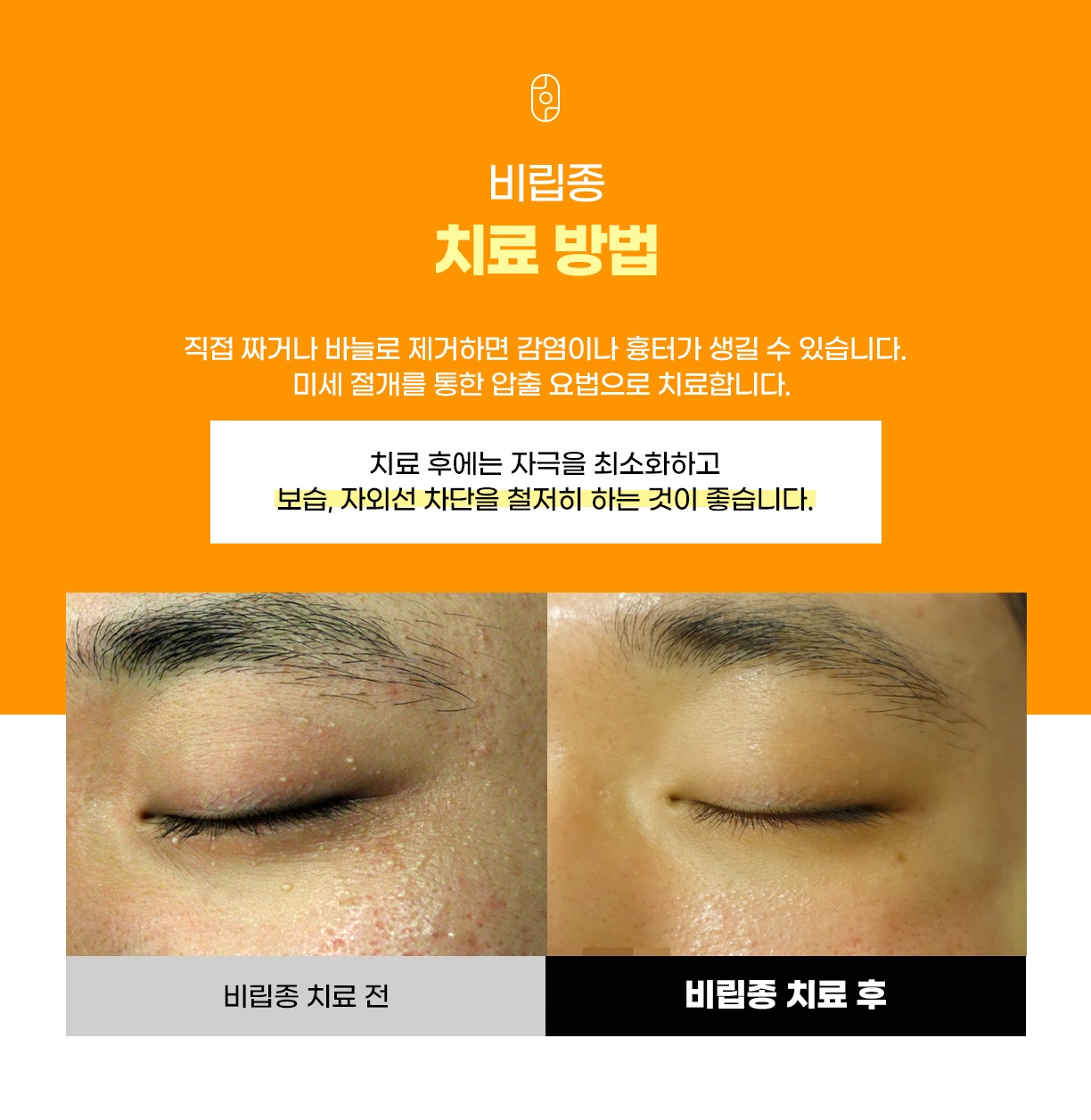 눈가 비립종을 미세 절개 압출로 치료한 전후 비교