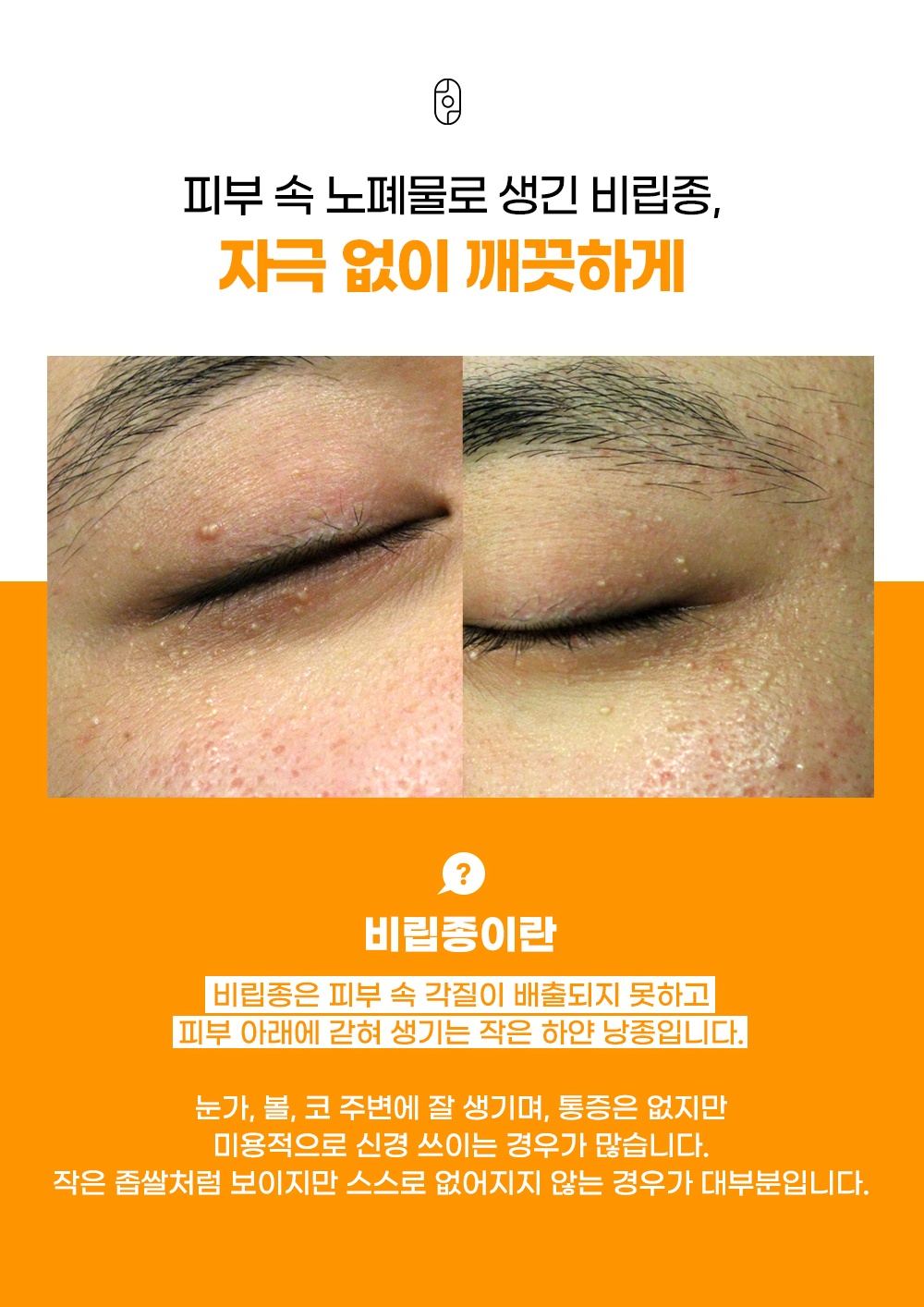 눈가와 볼에 자리 잡은 비립종을 자극 없이 치료한 전후 사진