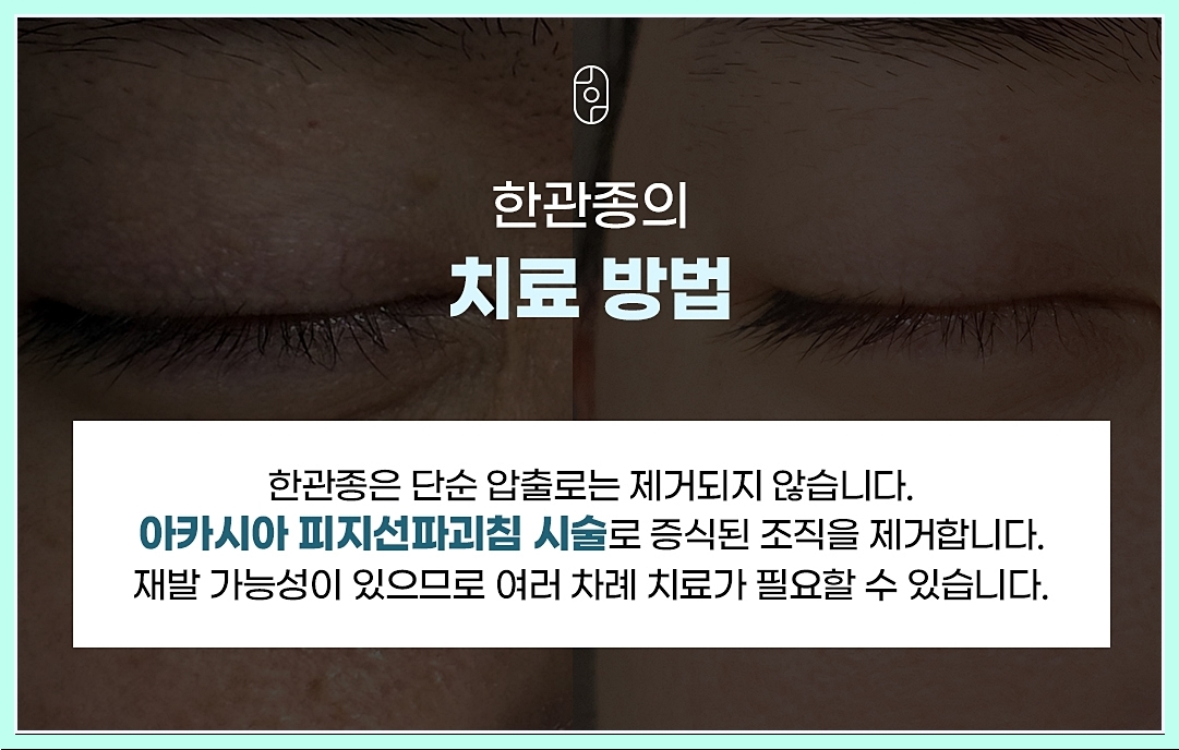 부천한관종 치료 방법 정리