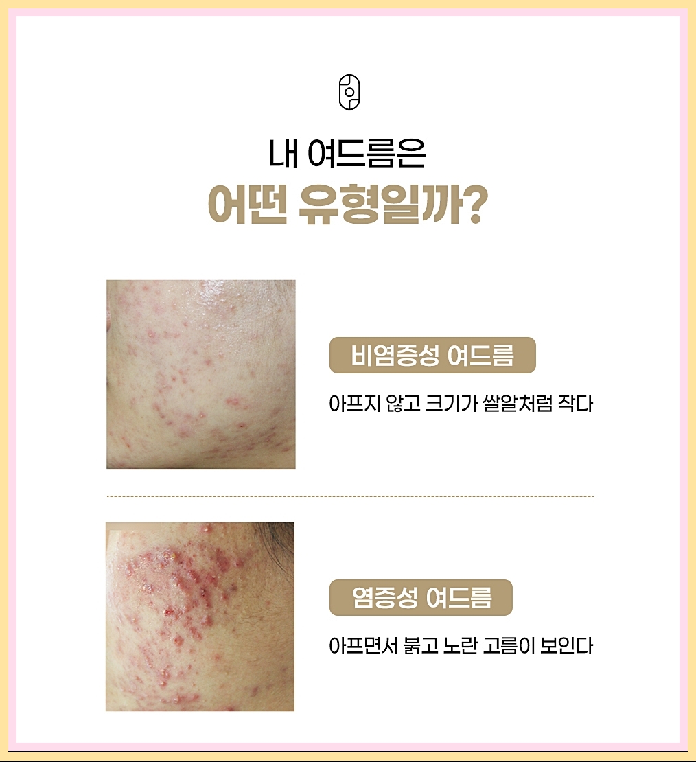 여드름의 두 가지 유형에 대한 설명 이미지