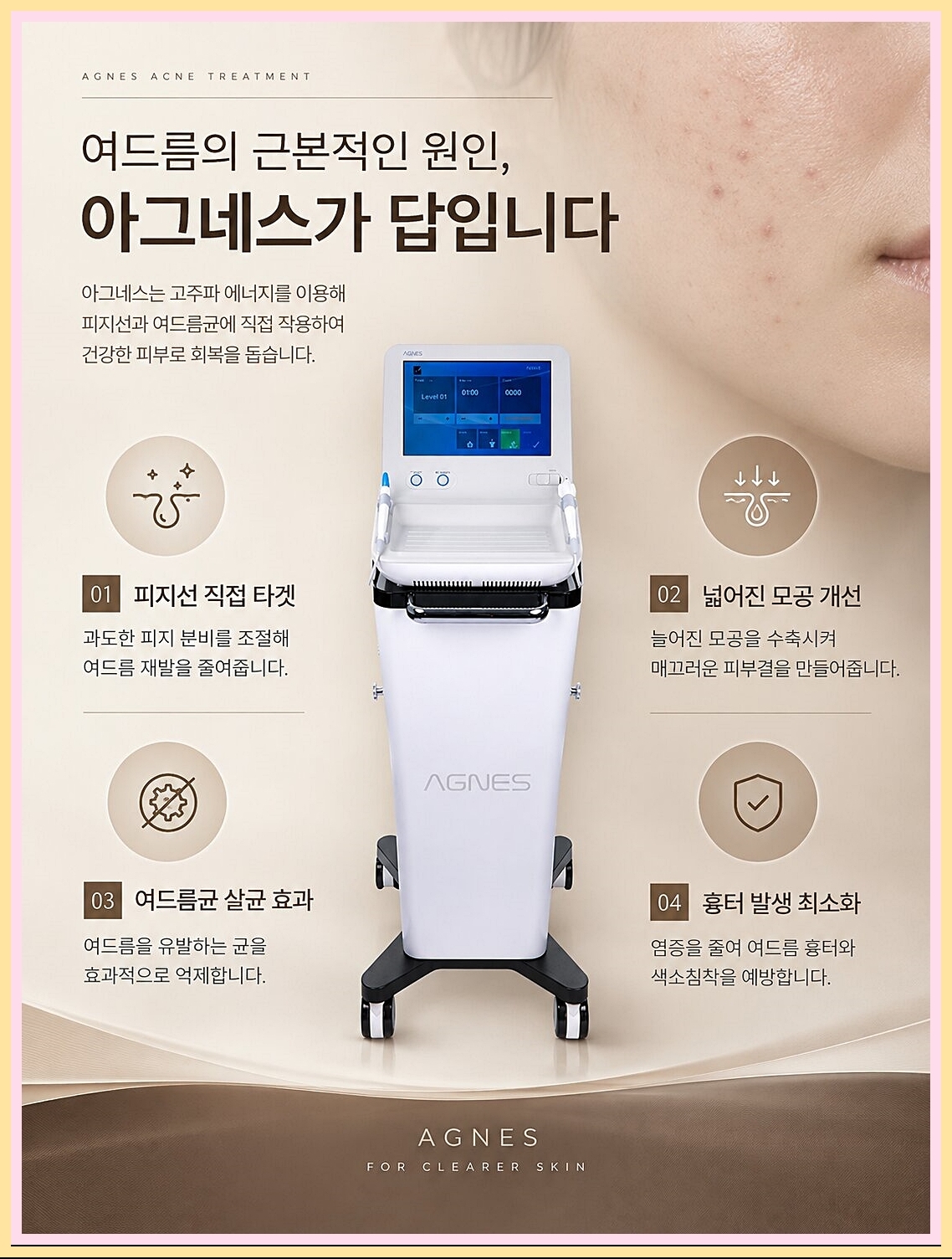 부천여드름 아그네스의 특장점 이미지