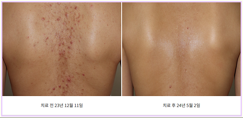 등여드름 필링 치료 전후 비교 이미지