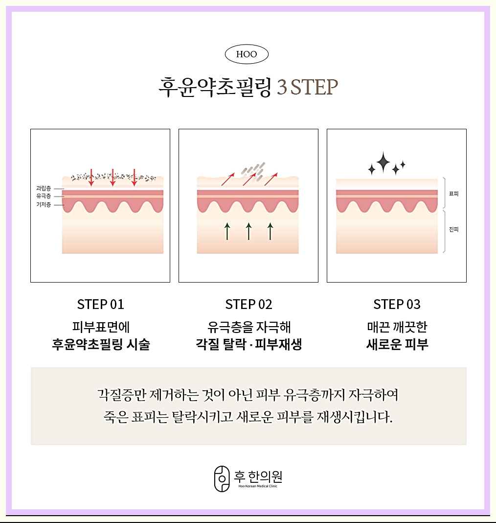 부천등여드름 시술 단계 3가지 이미지