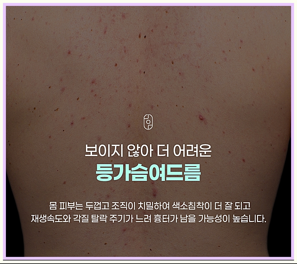 등가슴여드름의 특징 설명 이미지