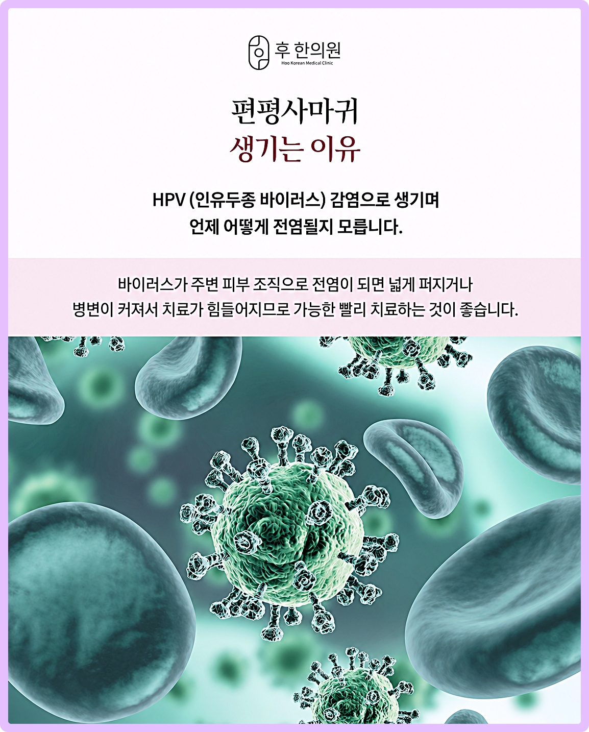 부천편평사마귀제거 편평사마귀가 생기는 이유 HPV 인유두종 바이러스 감염