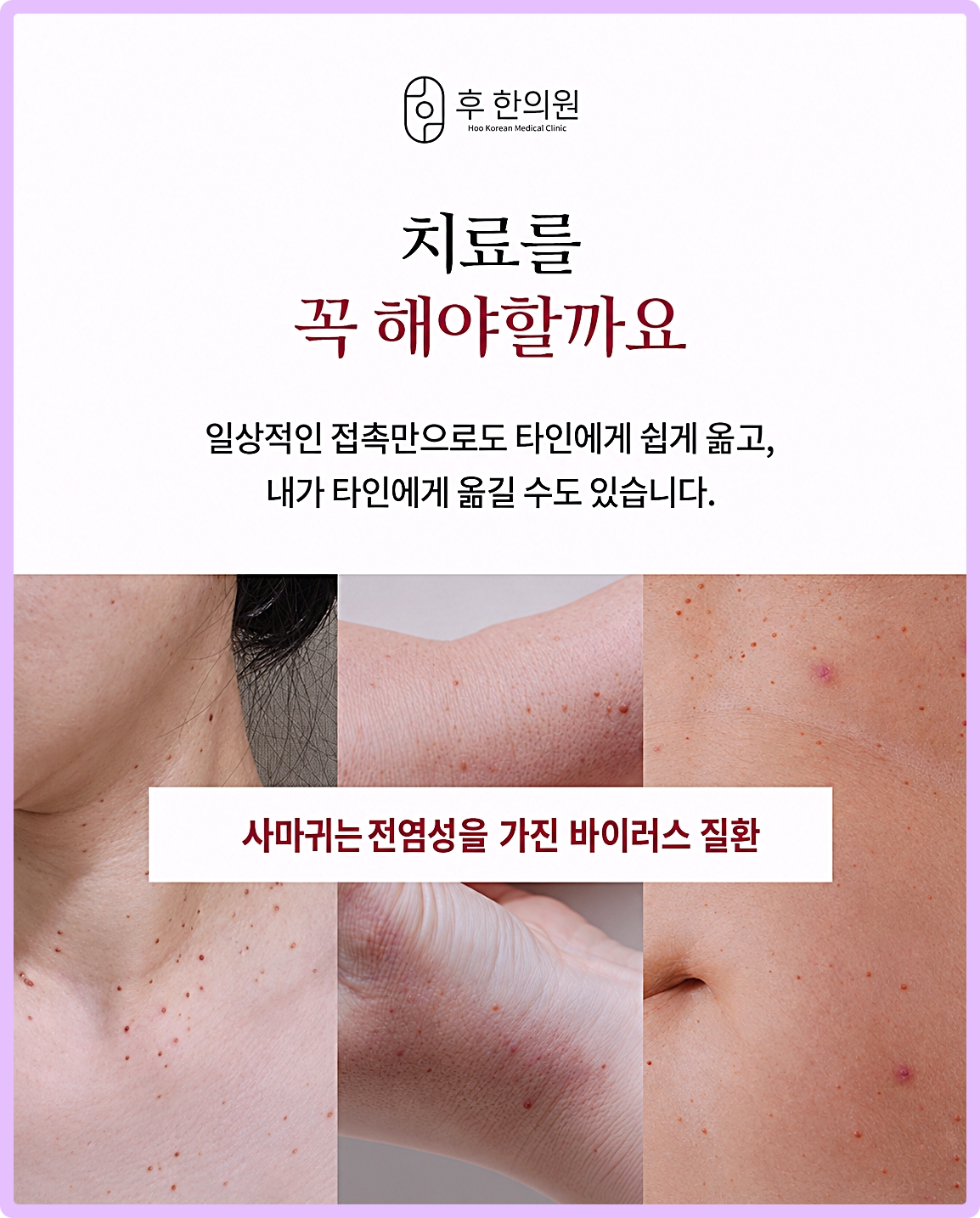 사마귀는 전염성을 가진 바이러스 질환 안내 목 팔 손목 병변