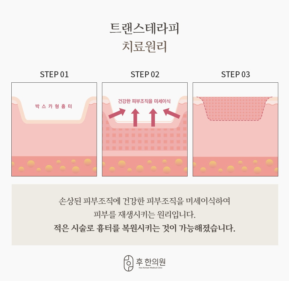 트랜스테라피 치료원리 3단계, 박스카형 여드름흉터에 건강한 피부조직을 미세이식해 재생시키는 과정