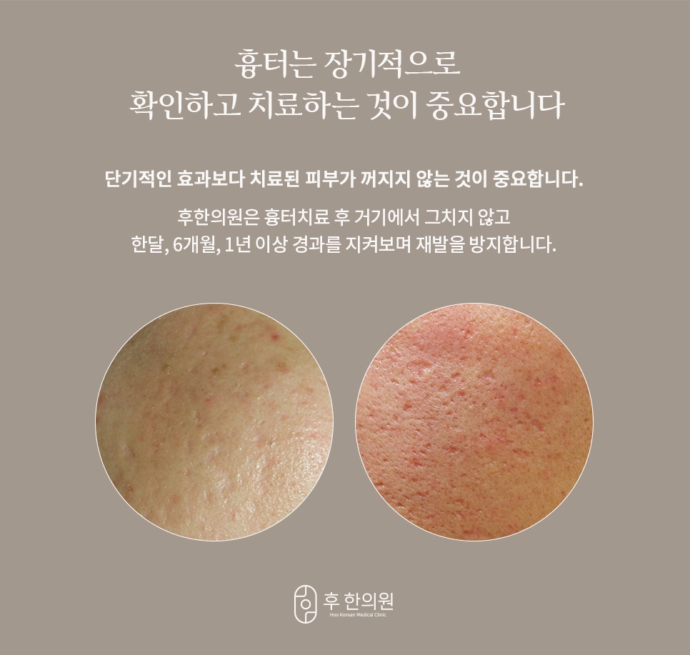 흉터 치료 후 한 달, 6개월, 1년 이상 경과를 지켜보며 재발을 방지하는 장기 관리 안내